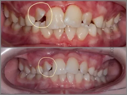 Виправлення прикусу брекети або пластинка, perfectsmile (естетична стоматологія) Виправлення прикусу брекети або пластинка, perfectsmile