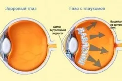 Вимірювання внутрішньоочного тиску