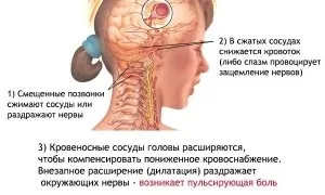 Які наслідки мігрені можуть бути і як їх уникнути (наслідки) Які наслідки мігрені можуть бути і як їх уникнути