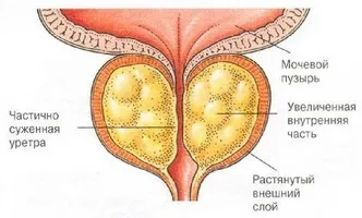 Як гріти простату при простатиті і чи можна це робити на думку лікарів (простатиті) Як гріти простату при простатиті і чи можна це робити на думку лікарів