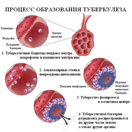 Які бувають ознаки при рецидив туберкульозу легенів (легких) Які бувають ознаки при рецидив туберкульозу легенів