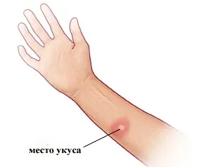 Укус гедзя симптоми, лікування (симптоми) Укус гедзя симптоми, лікування