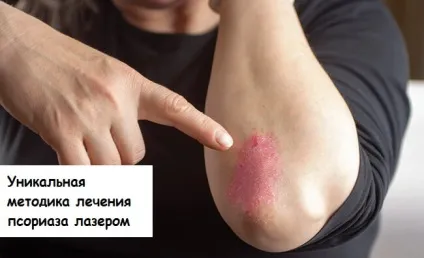 Унікальна методика лікування псоріазу лазером
