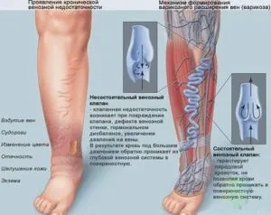 Як уникнути варикозу на ногах запобігти або зупинити варикоз (запобігти) Як уникнути варикозу на ногах запобігти або зупинити варикоз