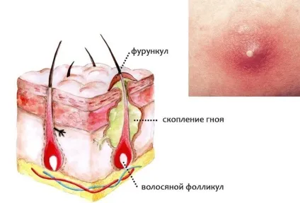 Як лікувати фурункул в домашніх умовах народними методами (домашніх) Як лікувати фурункул в домашніх умовах народними методами