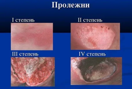 Як лікувати пролежні на сідницях у людей, прикутих до ліжка (людей) Як лікувати пролежні на сідницях у людей, прикутих до ліжка