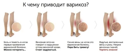Як запобігти і уникнути варикоз на ногах