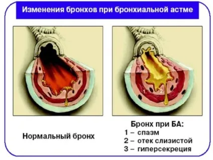 Як проявляється астма