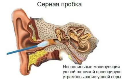 Вушні пробки симптоми і лікування у дорослих, у дитини (вушні пробки дітей лікування) Вушні пробки симптоми і лікування у дорослих, у дитини