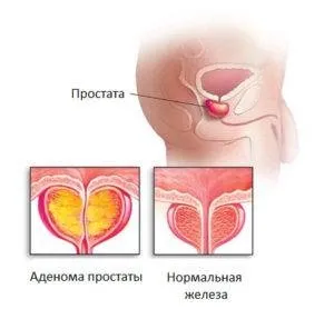 Як зробити масажер простати своїми руками, стимулятор і вібромасажер простати свій саморобний (масажер простати своїми) Як зробити масажер простати своїми руками, стимулятор і вібромасажер простати свій саморобний