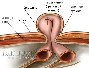 Як вилікувати пупкову грижу у дитини - сайт про розвиток дитини (діти) Як вилікувати пупкову грижу у дитини - сайт про розвиток дитини