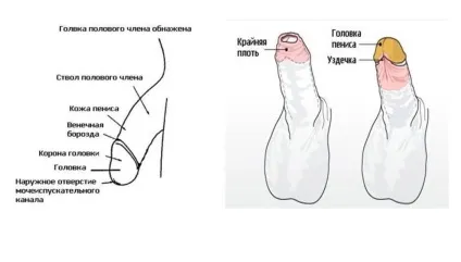 Як вилікувати фімоз в домашніх умовах - лікування народними засобами (домашніх) Як вилікувати фімоз в домашніх умовах - лікування народними засобами
