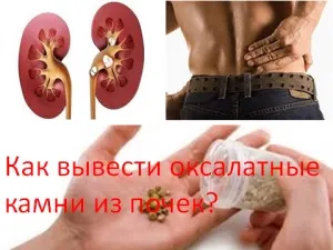 Як вивести оксалатних каменів з нирок, мій знахар (оксалатні) Як вивести оксалатних каменів з нирок, мій знахар