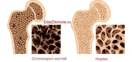 Як відновити кісткову тканину (кісткову) Як відновити кісткову тканину