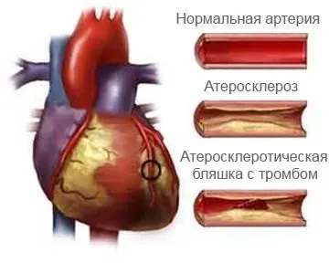 Як жити після стентування серця - осложения, дієта, реабілітація, ліки (після) Як жити після стентування серця - осложения, дієта, реабілітація, ліки