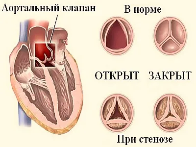 Кальциноз аорти, клапанів серця, судин що це таке, ступеня, лікування (клапанів) Кальциноз аорти, клапанів серця, судин що це таке, ступеня, лікування