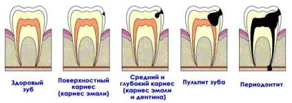 Карієс види, симптоми, способи лікування карієсу, пломбування зубів при карієсі, профілактика (карієсу) Карієс види, симптоми, способи лікування карієсу, пломбування зубів при карієсі, профілактика