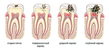 Карієс види, симптоми, способи лікування карієсу, пломбування зубів при карієсі, профілактика (лікування) Карієс види, симптоми, способи лікування карієсу, пломбування зубів при карієсі, профілактика
