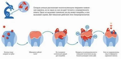 Карієс види, симптоми, способи лікування карієсу, пломбування зубів при карієсі, профілактика (карієсі) Карієс види, симптоми, способи лікування карієсу, пломбування зубів при карієсі, профілактика