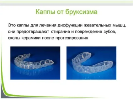 Капа для зубів стоматологічна - види, застосування і догляд (стоматологічна) Капа для зубів стоматологічна - види, застосування і догляд