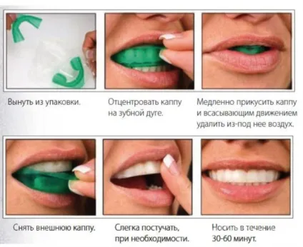 Капа для зубів стоматологічна - види, застосування і догляд (зубів) Капа для зубів стоматологічна - види, застосування і догляд