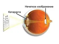 Катаракта причини, симптоми, лікування і профілактика, очі і зір (лікування) Катаракта причини, симптоми, лікування і профілактика, очі і зір