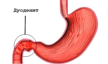 Кашель і пронос у дитини що робити і як правильно лікувати (дитини) Кашель і пронос у дитини що робити і як правильно лікувати