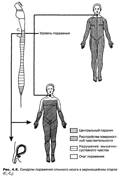 Кіфоз шийного відділу хребта симптоми, причини появи, лікування (патологічний кіфоз шийний відділ хребта лікування симптоми) Кіфоз шийного відділу хребта симптоми, причини появи, лікування