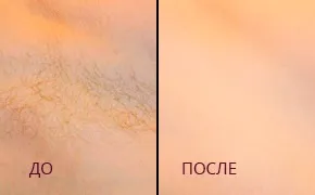 Комплекс для депіляції lowa-lowa (депіляції) Комплекс для депіляції lowa-lowa