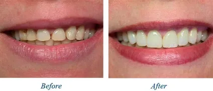 Компонуються термін служби, ціна, фото до і після (ціна) Компонуються термін служби, ціна, фото до і після