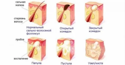 Комедони на обличчі, лобі, спині що це таке, причини чому постійно з'являються (спині) Комедони на обличчі, лобі, спині що це таке, причини чому постійно з'являються