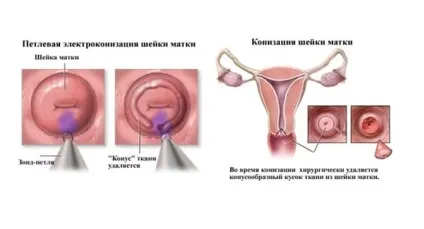 Конізація шийки матки як проходить операція і післяопераційний період (шийки) Конізація шийки матки як проходить операція і післяопераційний період