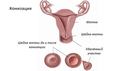 Конізація шийки матки як проходить операція і післяопераційний період (конизация) Конізація шийки матки як проходить операція і післяопераційний період