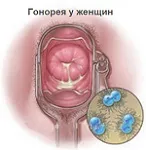 Кремоподібні виділення (кремові, як крем) білі, без запаху, з кислим запахом, після овуляції, (крем) Кремоподібні виділення (кремові, як крем) білі, без запаху, з кислим запахом, після овуляції,