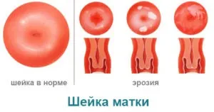 Кремоподібні виділення (кремові, як крем) білі, без запаху, з кислим запахом, після овуляції, (кремові) Кремоподібні виділення (кремові, як крем) білі, без запаху, з кислим запахом, після овуляції,