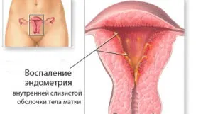 Кремоподібні виділення (кремові, як крем) білі, без запаху, з кислим запахом, після овуляції, (кремові) Кремоподібні виділення (кремові, як крем) білі, без запаху, з кислим запахом, після овуляції,
