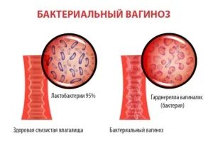 Кремоподібні виділення (кремові, як крем) білі, без запаху, з кислим запахом, після овуляції, (кремоподібні) Кремоподібні виділення (кремові, як крем) білі, без запаху, з кислим запахом, після овуляції,