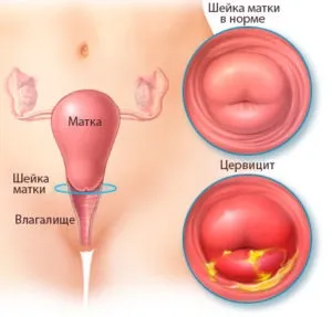 Кремоподібні виділення (кремові, як крем) білі, без запаху, з кислим запахом, після овуляції, (крем) Кремоподібні виділення (кремові, як крем) білі, без запаху, з кислим запахом, після овуляції,