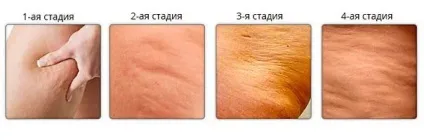 Крем з аминофиллином проти целюліту, наскільки він ефективний, як застосовувати, фото і відео поради (аминофиллином) Крем з аминофиллином проти целюліту, наскільки він ефективний, як застосовувати, фото і відео поради