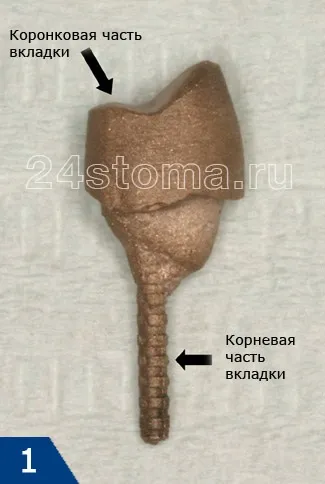 Культьова вкладка відновлення коронкової частини зуба (вкладка) Культьова вкладка відновлення коронкової частини зуба