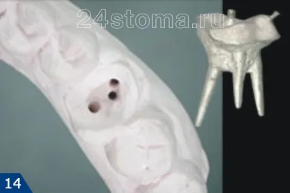 Культьова вкладка відновлення коронкової частини зуба (частини) Культьова вкладка відновлення коронкової частини зуба