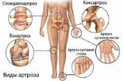 Лазерна терапія при артрозі лікування артрозу за допомогою лазера, в яких випадках можна застосовувати (лазерна) Лазерна терапія при артрозі лікування артрозу за допомогою лазера, в яких випадках не можна застосовувати