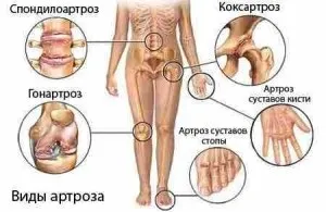 Лікування деформуючого артрозу суглобів (артрозу) Лікування деформуючого артрозу суглобів