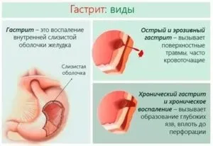 Лікування гастриту у дітей особливості, симптоми, методи (дітей) Лікування гастриту у дітей особливості, симптоми, методи