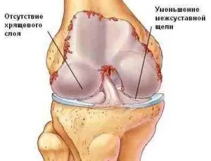 Лікування деформуючого артрозу суглобів (артрозу) Лікування деформуючого артрозу суглобів