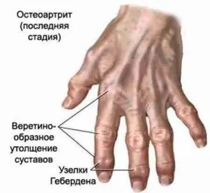 Лікування деформуючого артрозу суглобів (лікування деформуючого артрозу) Лікування деформуючого артрозу суглобів