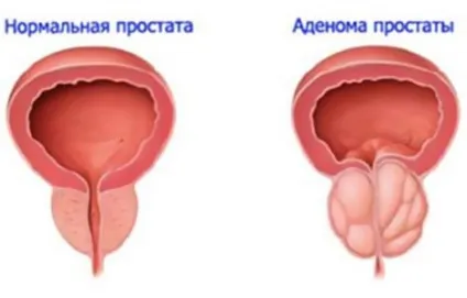 Лікування аденоми народними засобами (найефективніші) (аденоми) Лікування аденоми народними засобами (найефективніші)