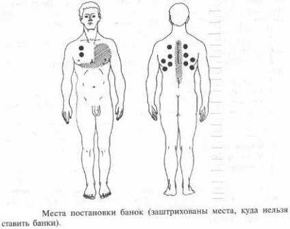 лікування банками