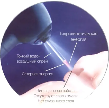 Лазерна стоматологія в москві, ціни в клініки лазерної стоматології (стоматологія) Лазерна стоматологія в москві, ціни в клініки лазерної стоматології