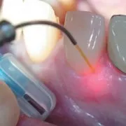 Лікування захворювань ясен лазером (ясен) Лікування захворювань ясен лазером